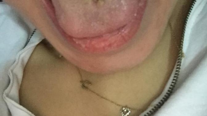 Dilimdeki piercing iltihap kaptı bakımı nasıl yapsam düzelir?