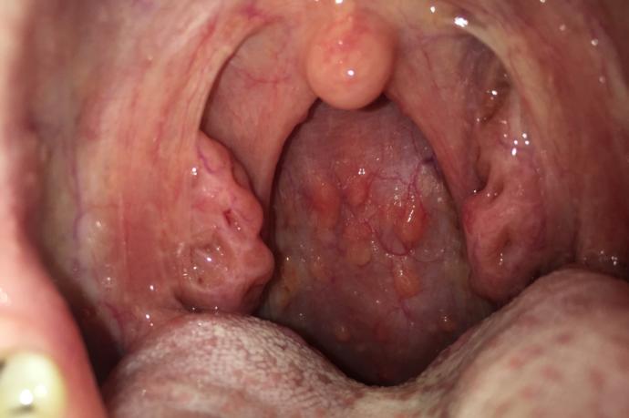 arkadaşlar boğazım bu durumda acayip bir acı yanma hissi doktor sadece antibiyotik verdi napmalıyım?