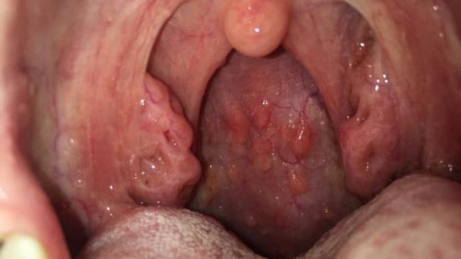 Arkadaşlar boğazım bu durumda acayip bir acı yanma hissi doktor sadece antibiyotik verdi napmalıyım?