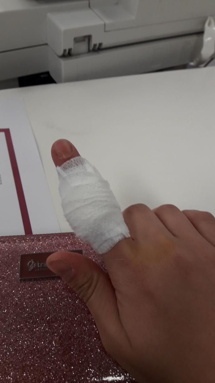 Parmağım kesıldı 3 gun oldu dikiş attırmadım derisi hala kalkık resimli bakar mısınız?