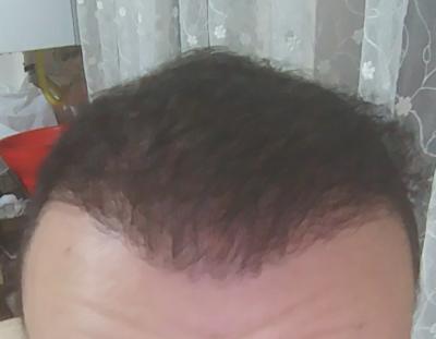 Sac Ekimi Sonucum Nasil Duruyor Bir Seans Daha Yapilmali Mi Kizlarsoruyor