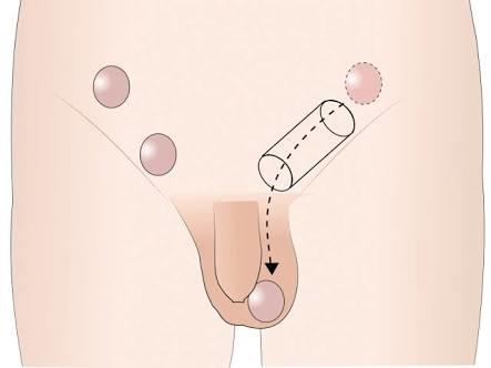 İnmemiş testis kısırlığa yol açıyormuş, erkek bebeklerin testis kontrolünü yapıyor musunuz?