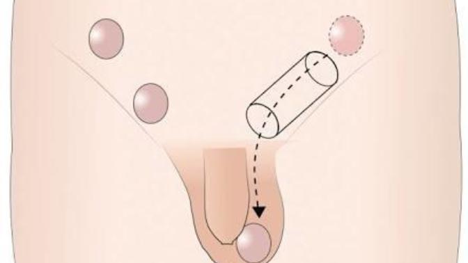 İnmemiş testis kısırlığa yol açıyormuş, erkek bebeklerin testis kontrolünü yapıyor musunuz?