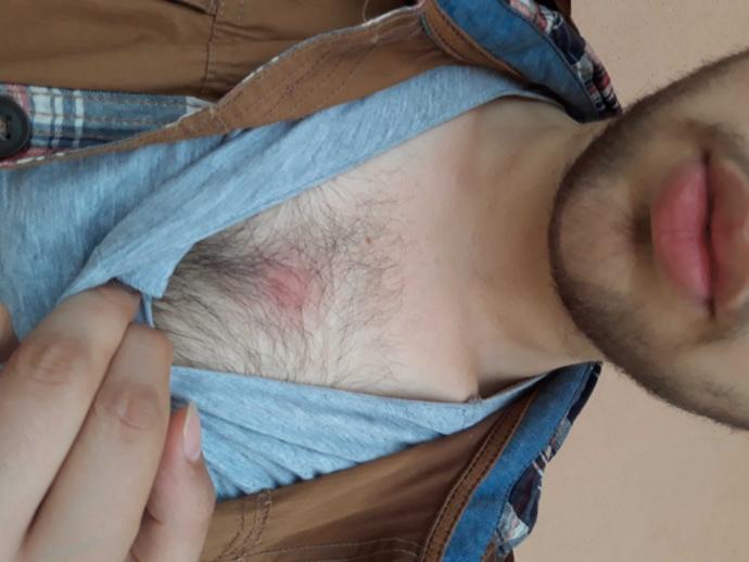Sivilce degil dokununca aciyor ne olabilir bu?