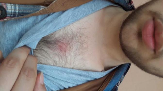 Sivilce degil dokununca aciyor ne olabilir bu?