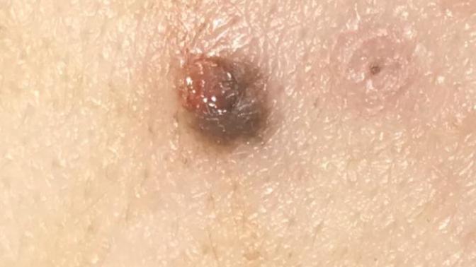 Yüzümdeki ben koptu. Bir şey olur mu acaba?