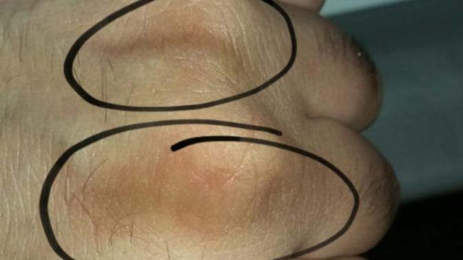 Elimin üstünde böyle birşey oluştu. cilt hastaliklarindan anlayan var mı?