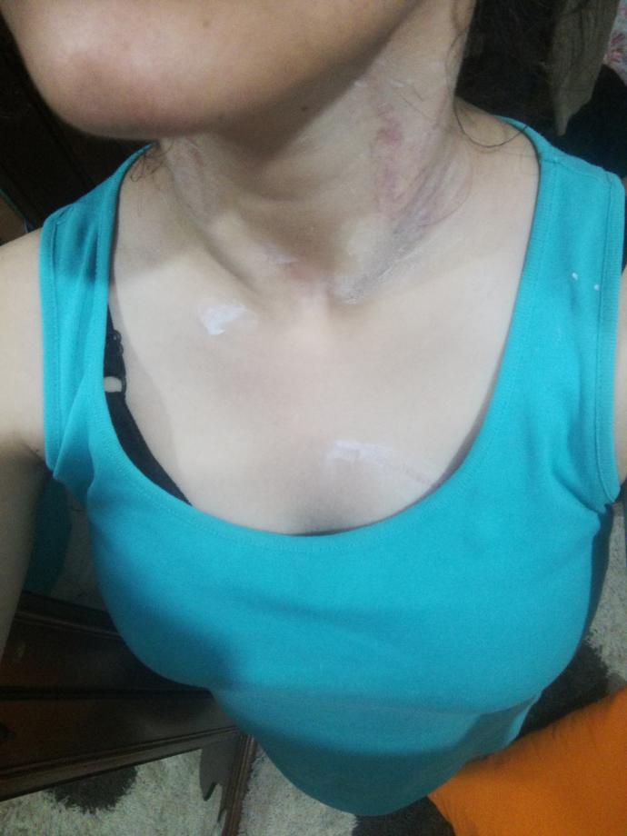 Arkadaşlar boynum cok mu kötü duruyor? bu halde dışarı cikamam? Annem beni bogmaya çalıştı?