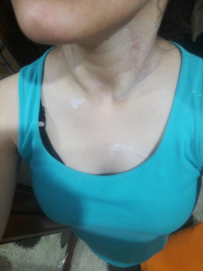 Arkadaşlar boynum cok mu kötü duruyor? bu halde dışarı cikamam? Annem beni bogmaya çalıştı?