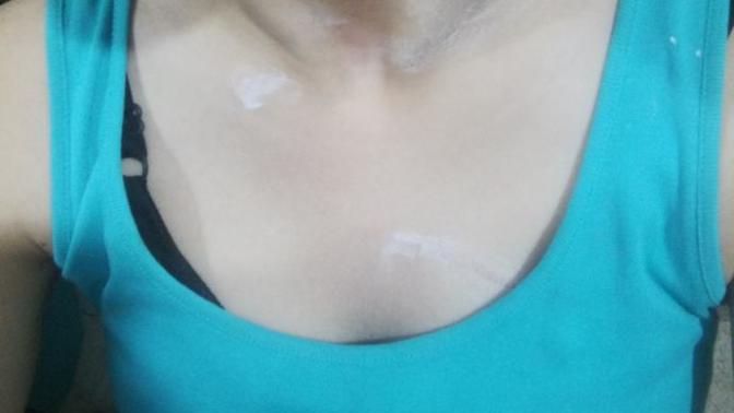 Arkadaşlar boynum cok mu kötü duruyor? bu halde dışarı cikamam? Annem beni bogmaya çalıştı?