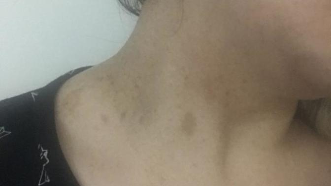 Boynumda ve vücudumun bazı bölgelerinde böyle lekeler var çok mu kötü duruyor? Bunların tedavisi var mı?