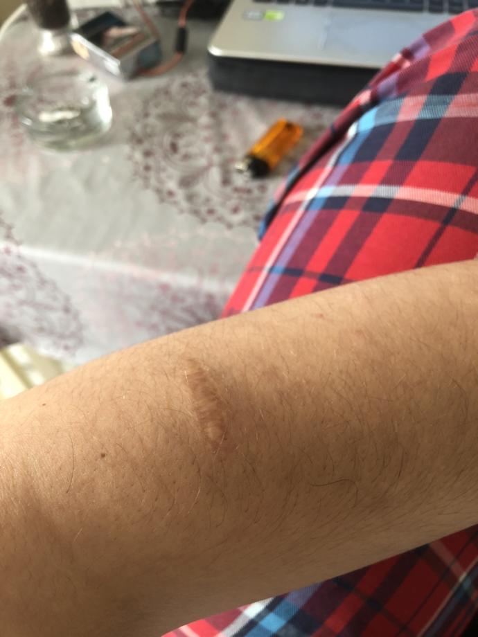 Vucudunuzda yara  ya da  dikis izi varmi?