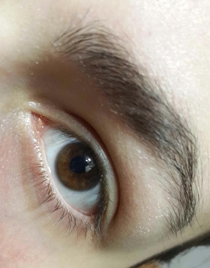 Kaş çevrem çok kuru bu egzama mıdır? Detayy?