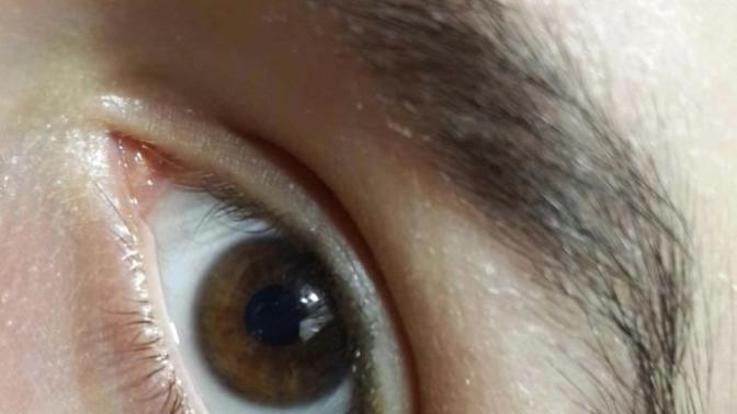 Kaş çevrem çok kuru bu egzama mıdır? Detayy?