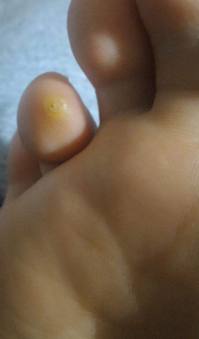 Ayağımın altında çıkan bu şey siğil mi, nasır mı?