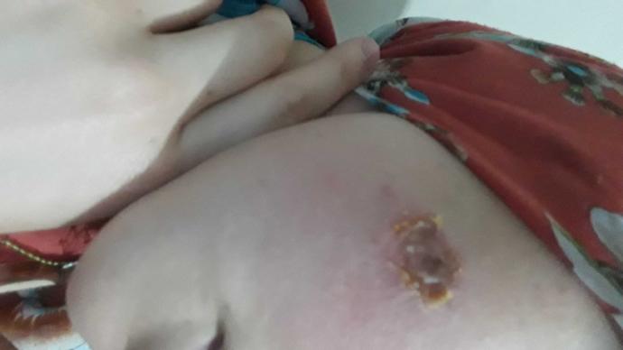 Yanağımdaki beni siyah nokta sanarak iğne ile çıkarmaya çalıştım kanadı ve büyük bir yara haline geldi?