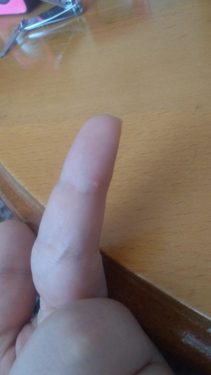 Parmağıma batan diken?