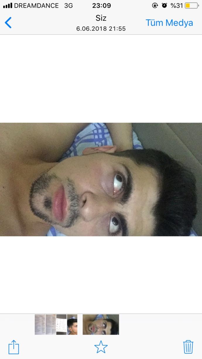 Benim gibi göz altlarının altı kızarıp moraran var mı?