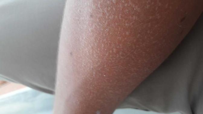Kolum güneş yanığı yüzünden su topladı kendi kendine geçermi?