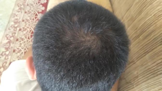 Saçım dökülüyor mu sizce?