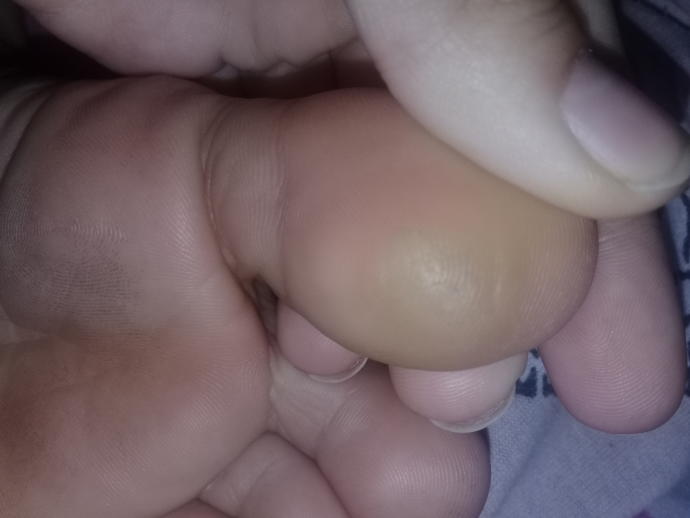 Sizce baş parmağımdaki nasır mı yoksa sertleşmiş deri mı ve bu nasıl geçer?