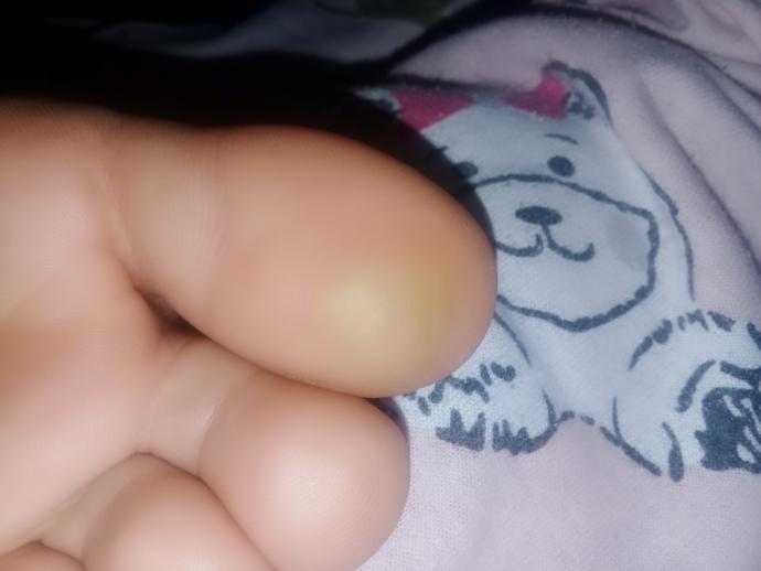 Sizce baş parmağımdaki nasır mı yoksa sertleşmiş deri mı ve bu nasıl geçer?