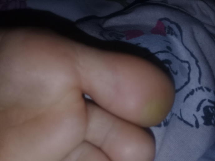 Sizce baş parmağımdaki nasır mı yoksa sertleşmiş deri mı ve bu nasıl geçer?