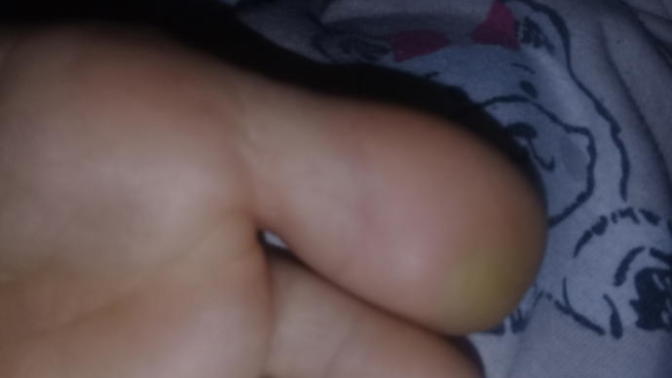 Sizce baş parmağımdaki nasır mı yoksa sertleşmiş deri mı ve bu nasıl geçer?
