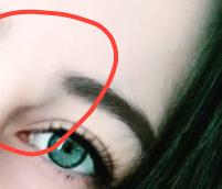Aranızda Epidermoid kist ameliyati olan var mi?