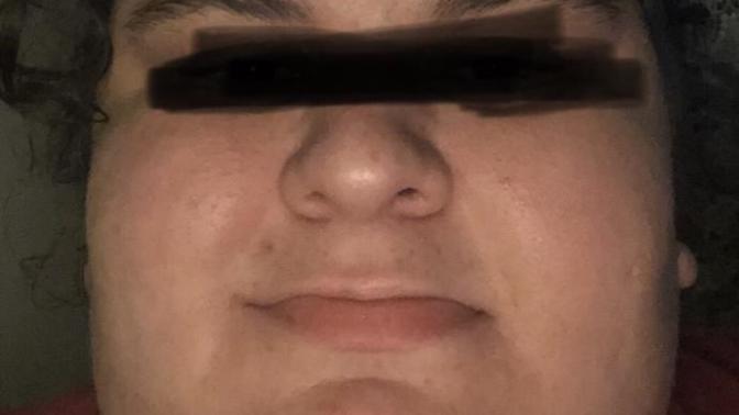 İkinci derece obezim. Yüzüm bu halde. Kilo verince tipimdeki deformasyon geçer mi?