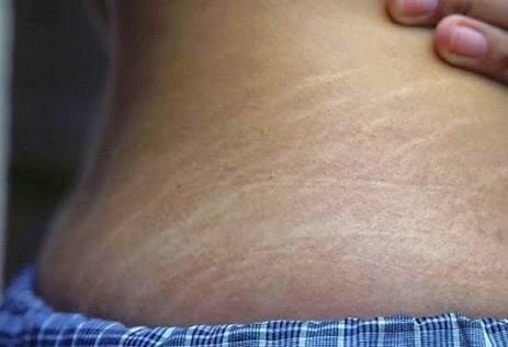 Sizce vücut çatlakları itici midir?