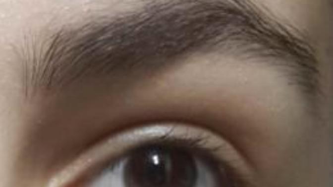 Göz kapaklarım çok etli ve düşük, estetik olsam mı?