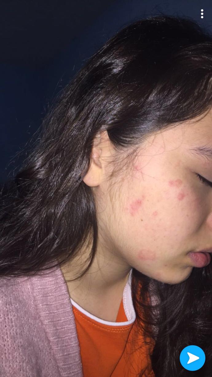 Bu cikti bide yuzumde bu ne simdi yakiyo bide, adam gibi anlayan varsa yazsin yardimci olsun?