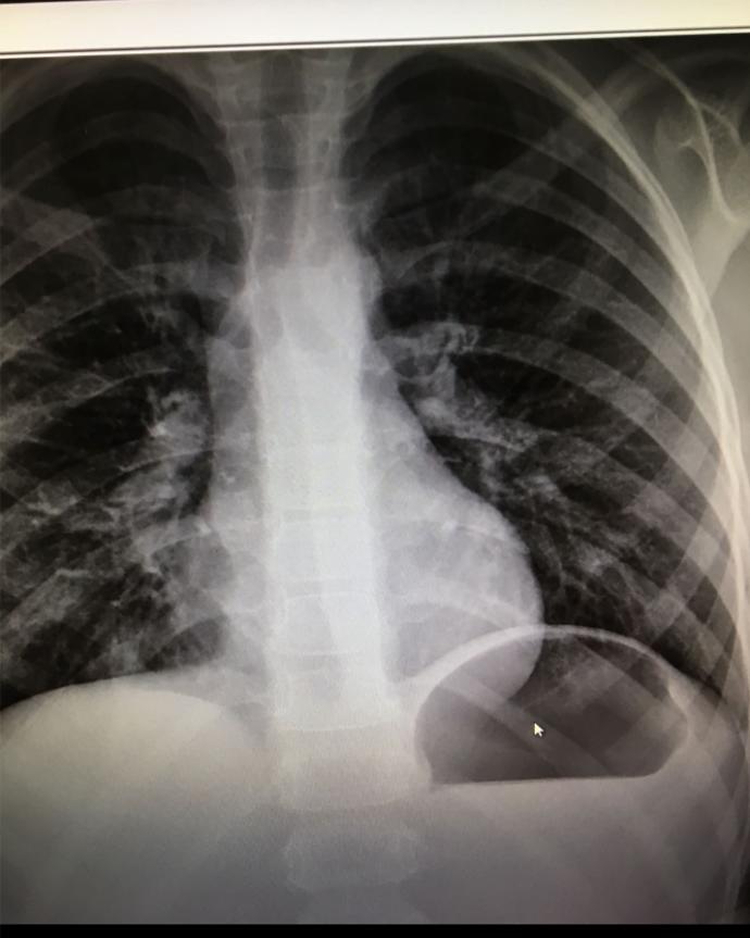 Akciğer filmini yorumlayacak doktor arkadaş var mi?