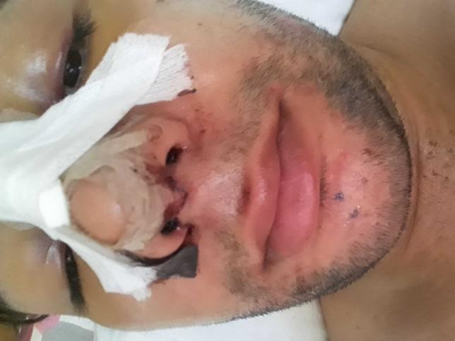 Burun estetiği oldum, kaç günde iyileşir?