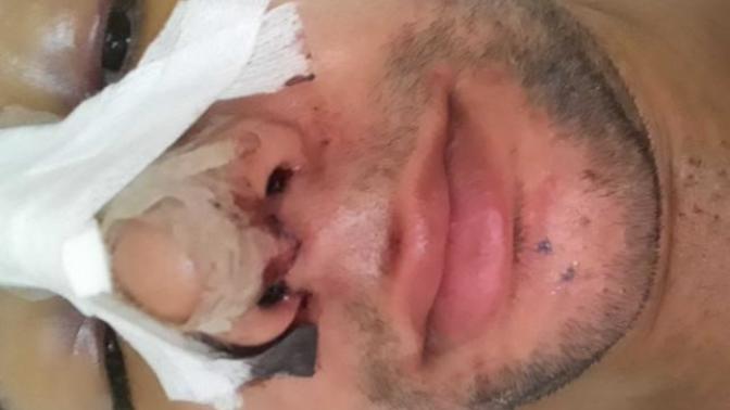 Burun estetiği oldum, kaç günde iyileşir?