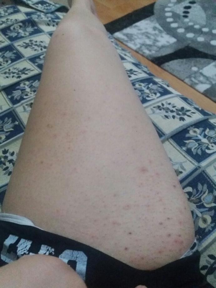 Bu sivilcelerin sebebi ne?