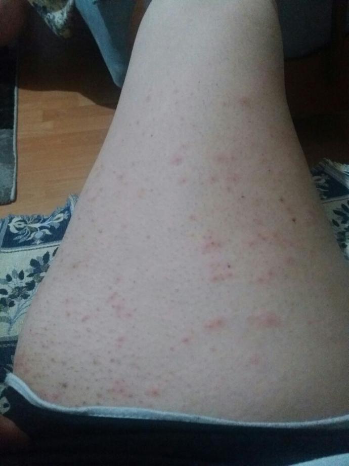 Bu sivilcelerin sebebi ne?