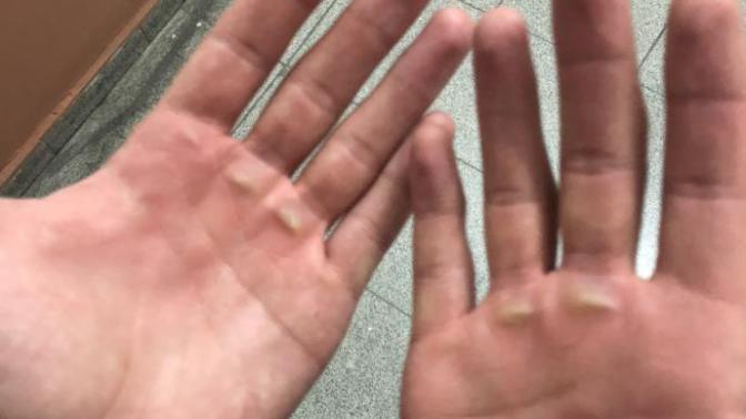 Barfiks çekmenin zararları nelerdir?