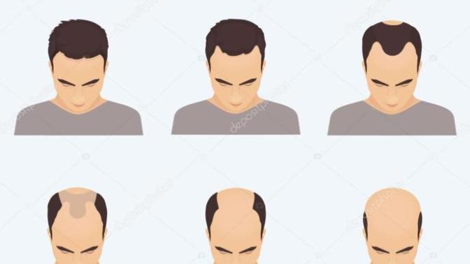 Hangi saç ekim tekniği daha mantıklıdır?
