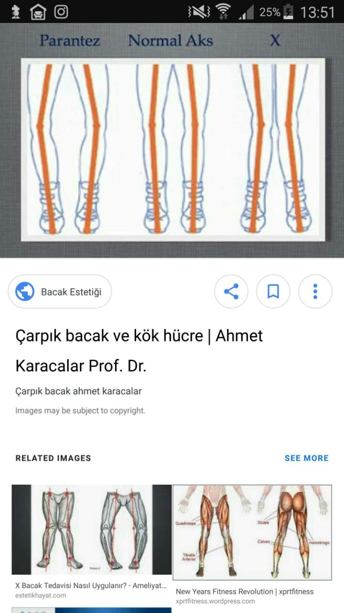 Çarpık bacak nasıl düzelir?