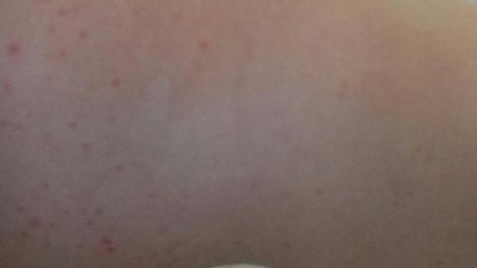 Iğneli epilasyon sonrası damar morarmasi normal mi? Dizimdeki damar şişti ve morardı. Foto var?