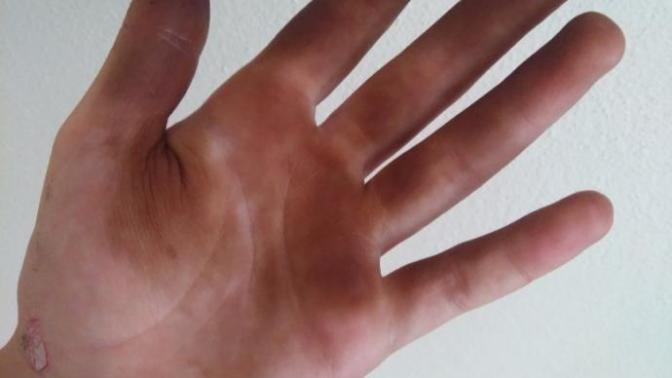 Eldeki ceviz kabuğu lekesi nasıl çıkar?