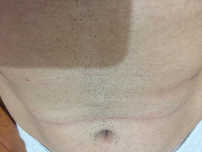 Birkaç gündür salonda ağırlıkla mekik ve demire asılarak alt karın çalışıyordum. Bu çizgiyi bugün farkettim ciddi bisey mi nedir bu?