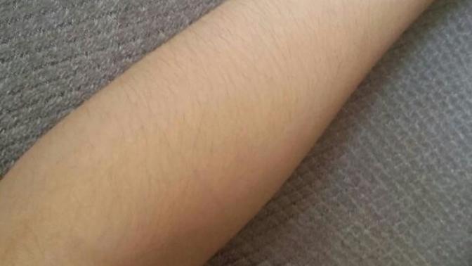 Kollarımı aldırmalı mıyım?