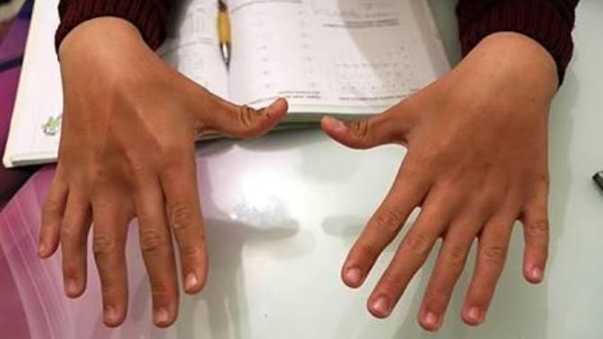 6 parmaklı insanlar hakkında ne düşünüyorsunuz?