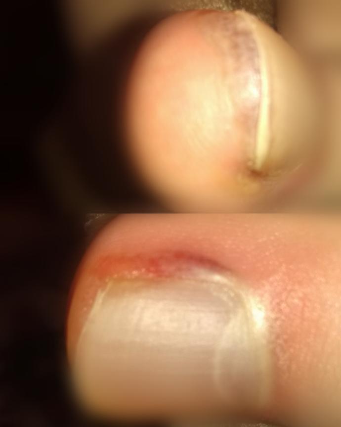 Ayak tırnağım çok kötü (Resimli) ne yapıcam tırnak batması mı bu?