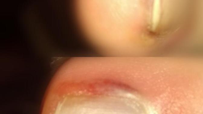 Ayak tırnağım çok kötü (Resimli) ne yapıcam tırnak batması mı bu?