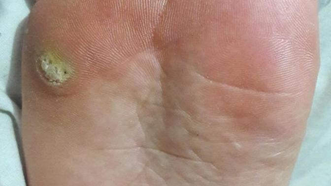 Ayak parmağımda boyle bişey çıktı yardim edin ne bu?