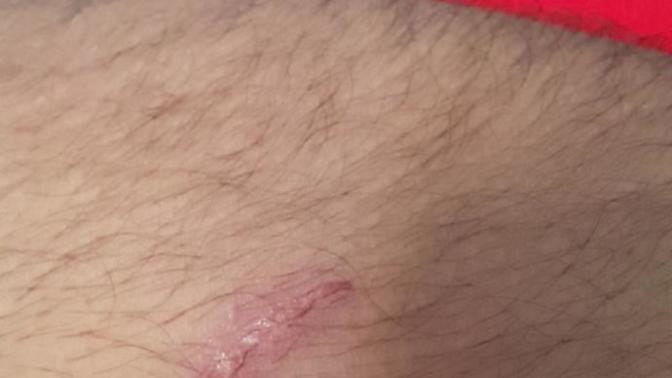 Derin tırnak izi yarası mikrop kapmış mıdıır?